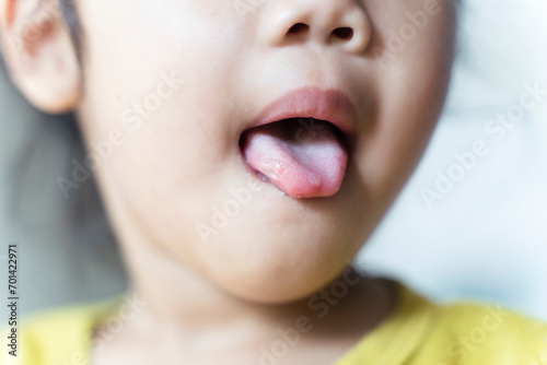 Hand-foot-and-mouth disease or HFMD, is caused by a virus. Close up of a infected wollen tongue with blisters. photo