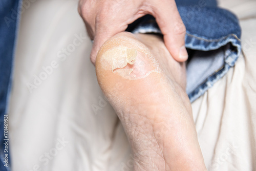 Broken and dry blister skin on the foot