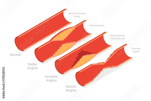 3D Isometric Flat  Illustration of Types Of Angina, Medical Educational Diagram photo