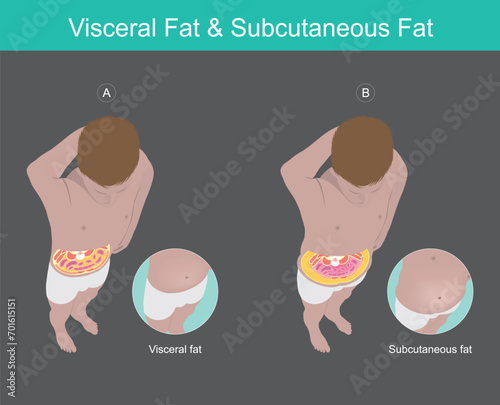 Visceral Fat & Subcutaneous Fat Illustration. Illustration knowledge of the abdomen visceral fat in human.