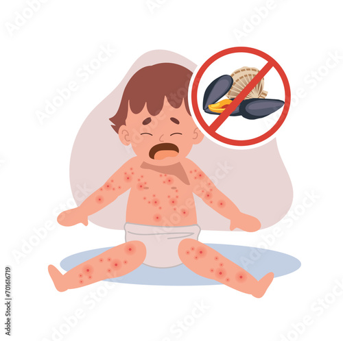 Allergic Reactions in Infants.  baby with skin rash. Baby Food Allergy from seafood or shellfish . shell free