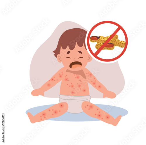 Allergic Reactions in Infants. baby with skin rash. Baby Food Allergy from peanut. Peanut Sensitivity