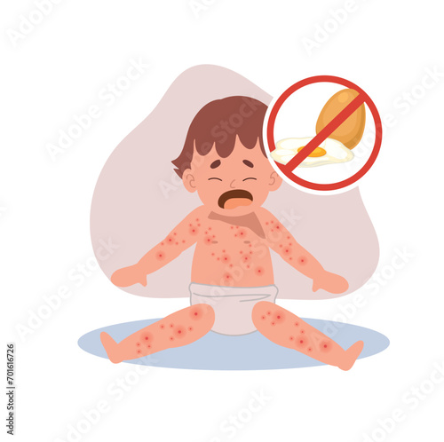 Allergic Reactions in Infants.  baby with skin rash. Baby Food Allergy from egg. egg free
