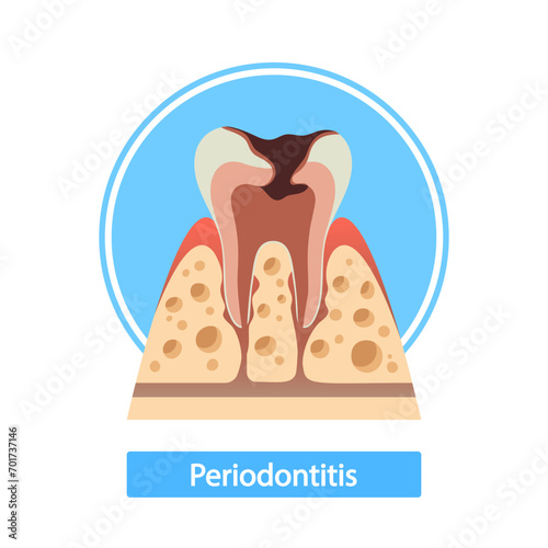 Periodontitis Cross-section Reveals Inflamed Gum Tissue, Bacterial Infection, And Bone Loss, Cartoon Vector Illustration