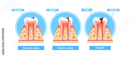 Stages Of Caries Infographics. Enamel Caries, Dentin Caries, And Pulpitis Cross Section View. Medical Visual Information