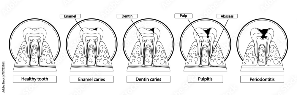 Stages Of Caries Infographic. Healthy Tooth, Enamel Caries, Dentin Caries, Pulpitis and Periodontitis Cross Section View - obrazy, fototapety, plakaty 