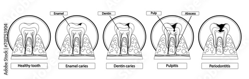 Stages Of Caries Infographic. Healthy Tooth, Enamel Caries, Dentin Caries, Pulpitis and Periodontitis Cross Section View photo