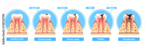 Caries Stages Infographics. Healthy Tooth, Enamel Caries, Dentin Caries, Pulpitis And Periodontitis Cross Section View