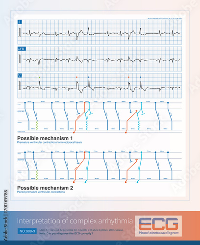 A middle-aged man sought medical attention due to palpitations. The electrocardiogram indicates arrhythmia. Can you correctly diagnose this electrocardiogram?