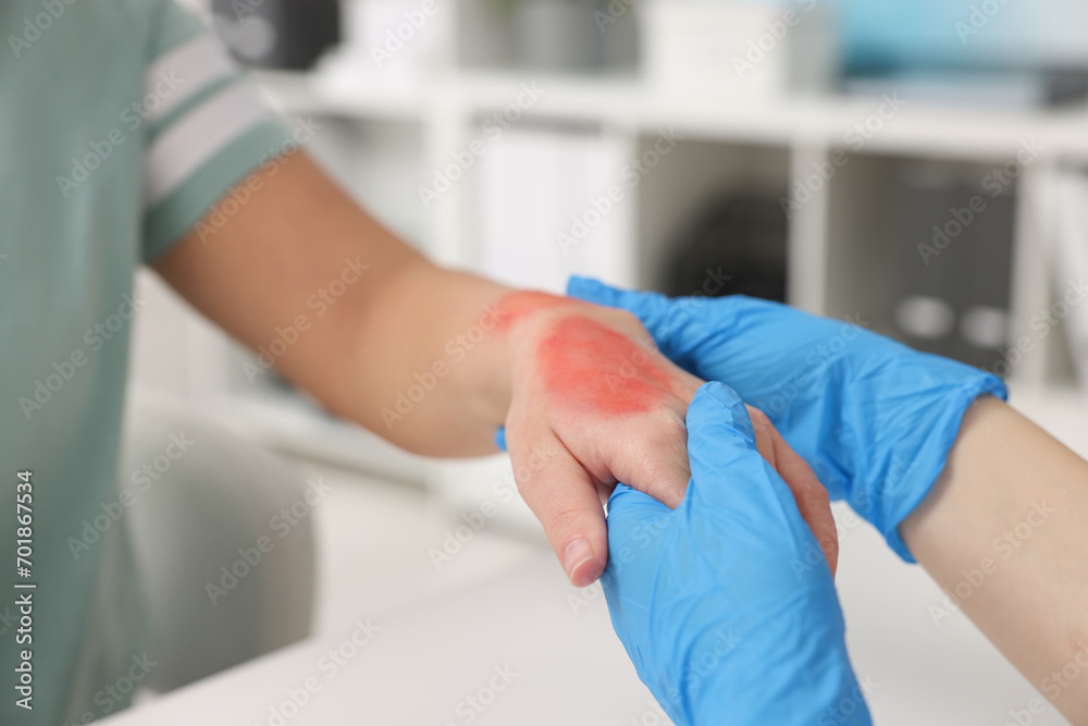 Doctor examining patient's burned hand indoors, closeup Doctor examining patient's burned hand indoors, closeup