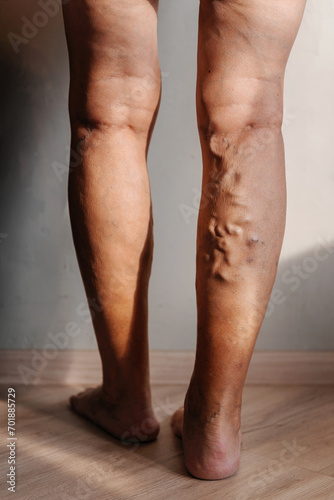 Varicose veins in a woman. swelling of veins in the legs of an elderly person. clogged veins with plugs on a person's legs photo