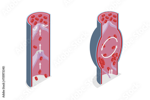 Foto 3D Isometric Flat  Illustration of Healthy And Varicose Vein, Educational Medica