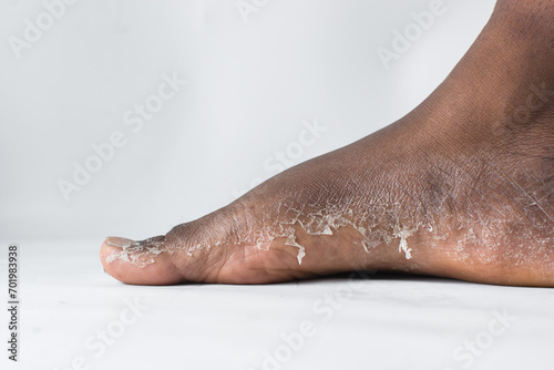 Process of foot peeling  brown skin foot in the process of peeling  skin shedding on a foot