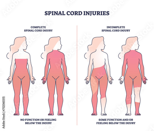 Spinal cord injuries with complete or incomplete trauma outline diagram. Labeled educational scheme with function or feeling zones in state of paralysis vector illustration. Medical neural condition. photo