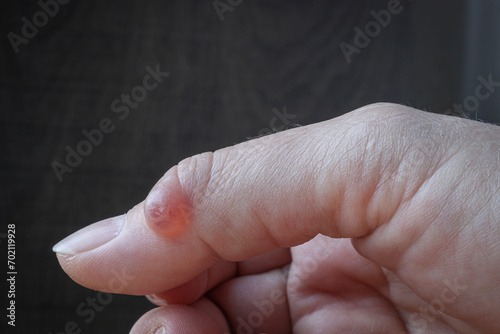 Hygroma (Ganglion cyst) of the thumb joint. Selective focus. photo
