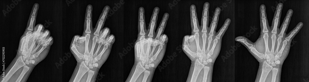 Film xray x-ray or radiograph of a hand and fingers showing the numbers one through five 1-5. One, two, three, four five in gestural language, manual communication, or signing aka sign language Film xray x-ray or radiograph of a hand and fingers showing the numbers one through five 1-5. One, two, three, four five in gestural language, manual communication, or signing aka sign language