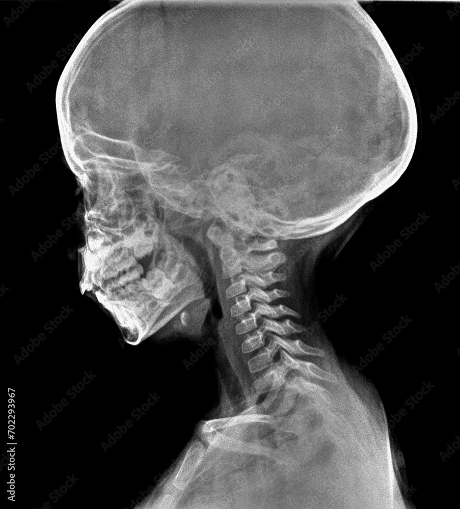 Normal film xray or radiograph of a cervical neck of a small child ...