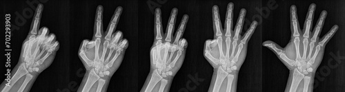 Film xray x-ray or radiograph of a hand and fingers showing the numbers one through five 1-5.  One, two, three, four five in gestural language, manual communication, or signing aka sign language photo