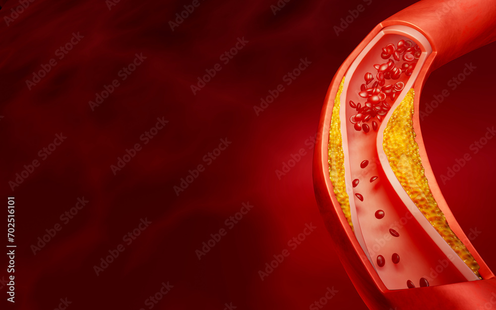 Hyperlipidemia or arteriosclerosis. Blocked artery concept and human