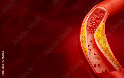 Hyperlipidemia or arteriosclerosis. Blocked artery concept and human blood vessel as a disease with cholesterol fat buildup clogging. Clogged arteries, Cholesterol plaque in the artery. 3D Rendering photo