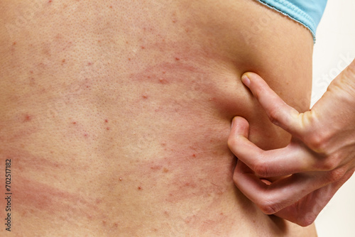 Woman scratching her itchy back with allergy rash