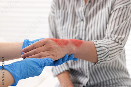 Doctor examining patient s burned hand indoors  closeup