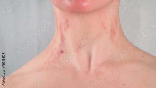 Bruised young Woman Neck. Domestic Violence Results. Traces of Violence. Protecting Women's rights Concept. No Face Photo