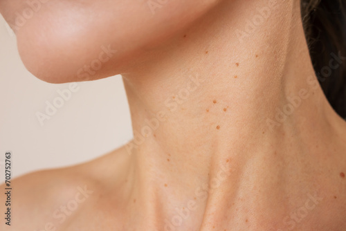 close-up photo of the neck of a young woman suffering from many brown growths on the skin, papillomas, is experiencing discomfort. Skin diseases. Human papillomavirus. Laser removal of papillomas