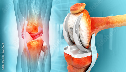 Knee Joint Replacement Surgery. 3d illustration photo