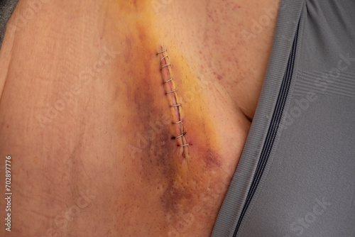 Nine staples to the groin scar on the body of an elderly gentleman after an inguinal hernia operation photo