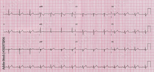 EKG Ausdruck