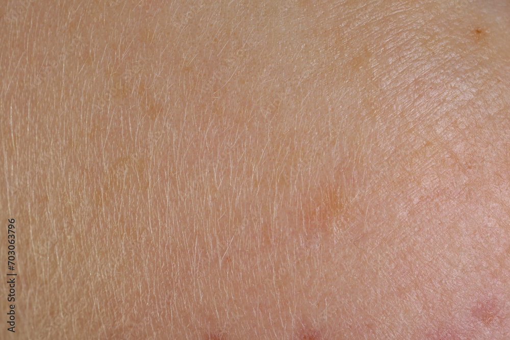 Texture of skin with birthmarks as background, macro view Texture of skin with birthmarks as background, macro view