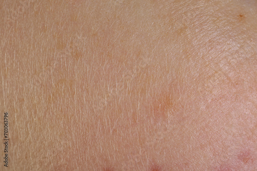 Texture of skin with birthmarks as background, macro view