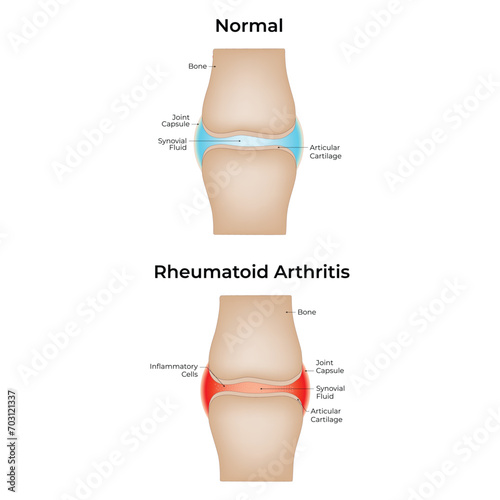 Normal and Rheumatoid Arthritis Science Design Vector Illustration