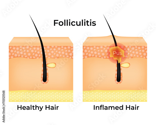 Folliculitis Science Design Vector Illustration Diagram