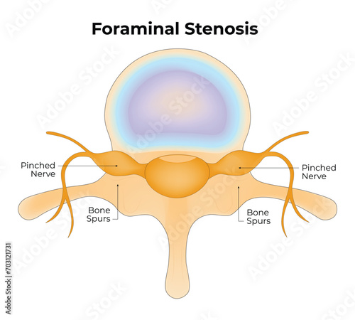 Foraminal Stenosis Science Design Vector Illustration