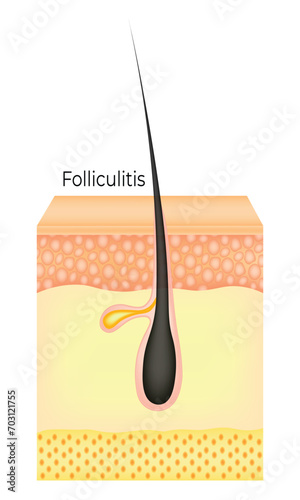 Folliculitis Science Design Vector Illustration Diagram