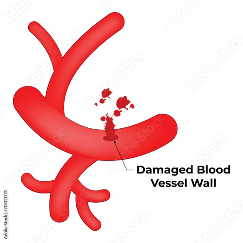 Damaged Blood Vessel Wall Science Design Vector Illustration