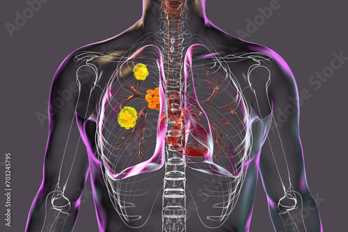 Pulmonary blastomycosis, 3D illustration