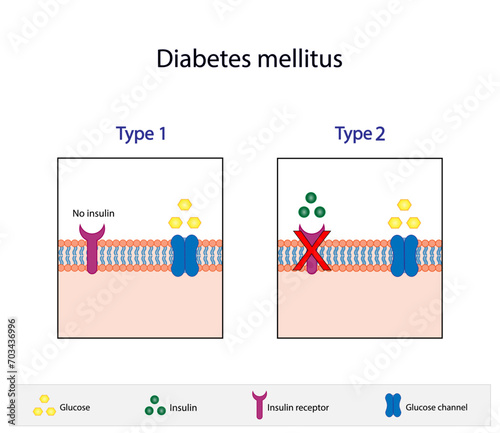 Diabetes mellitus type 1, pancreas's failure to produce enough insulin and type 2, cells fail to respond to insulin (Insulin resistance). Result in high blood glucose levels. Vector illustration.