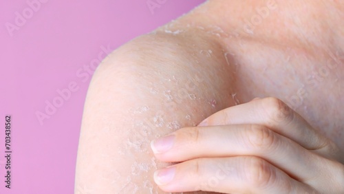 Skin is peeling shoulder with peeling skin close-up front view skin problems dry skin consequences of dehydration and dermatitis self care, concept of body and cosmetology hygiene and medicine