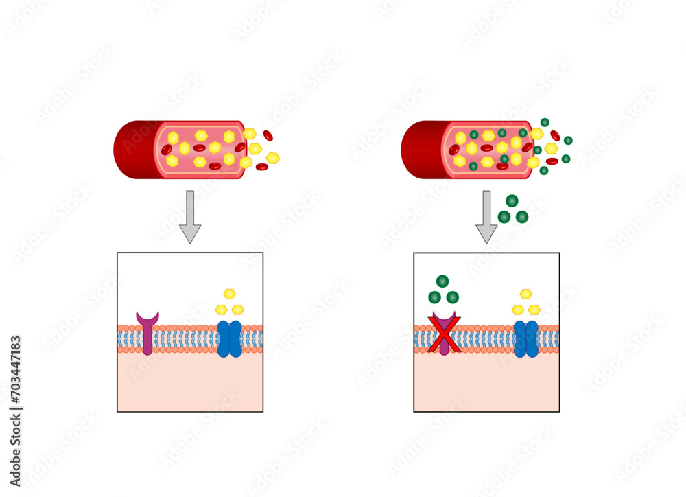 Diabetes mellitus type 1, pancreas's failure to produce enough insulin