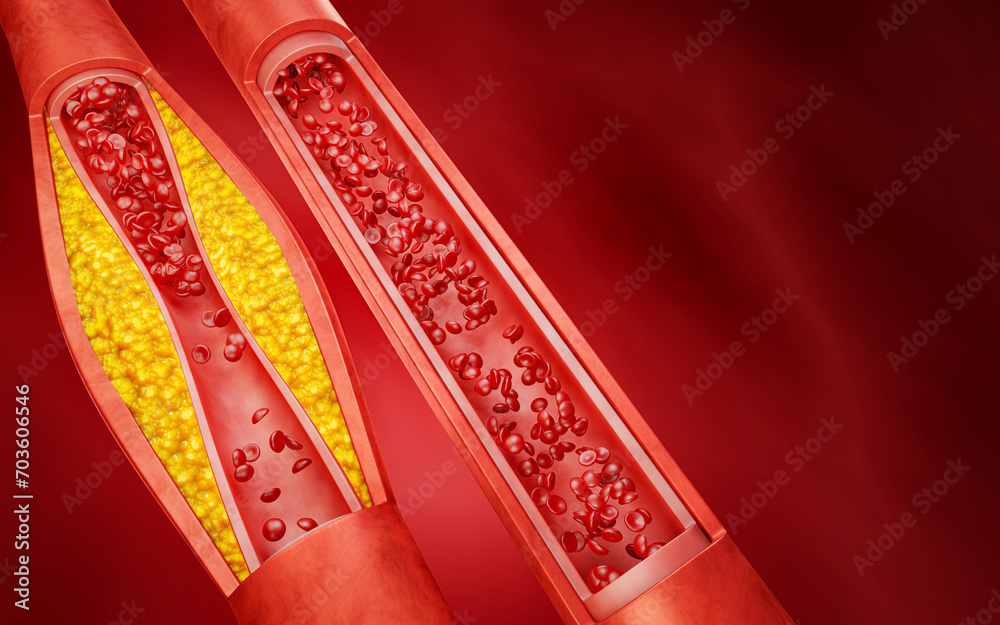 Hyperlipidemia or arteriosclerosis. Blocked artery concept and human blood vessel as a disease with cholesterol fat buildup clogging. Clogged arteries, Cholesterol plaque in the artery. 3D Rendering - obrazy, fototapety, plakaty 