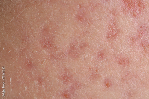 Texture of skin with acne problem as background, macro view photo
