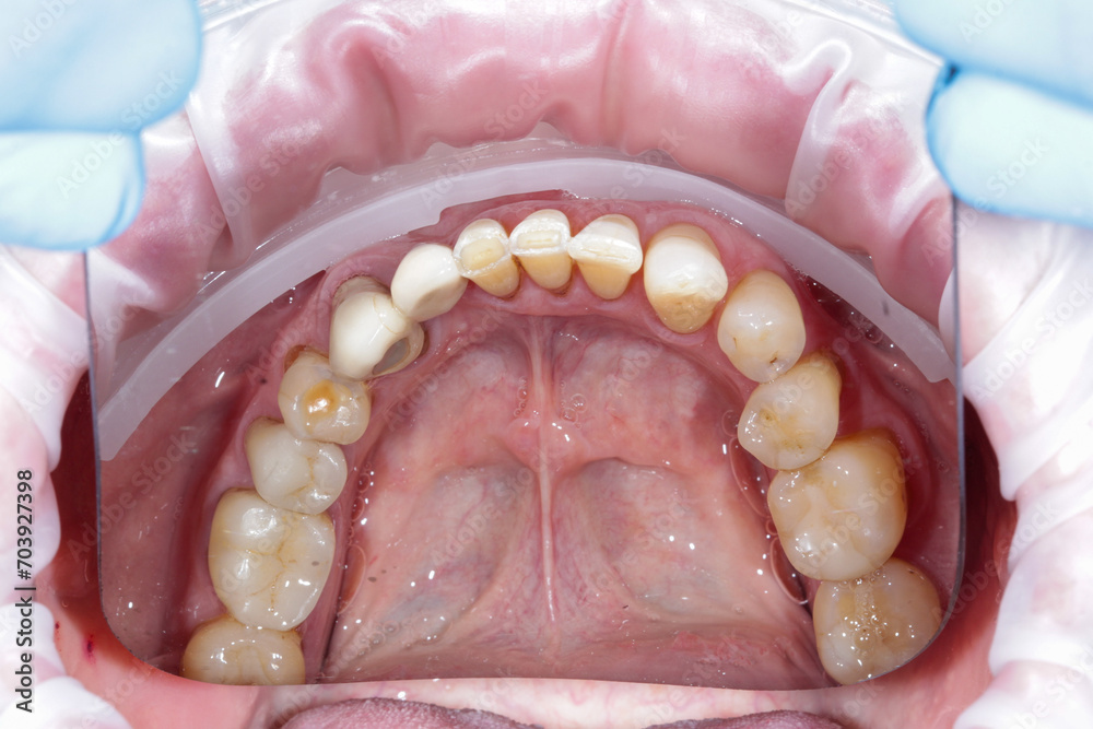 Dentistry. Human open mouth with dental decay