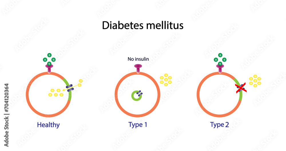 Diabetes mellitus type 1, pancreas's failure to produce enough insulin