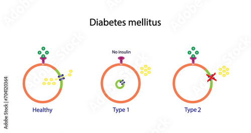 Diabetes mellitus type 1, pancreas's failure to produce enough insulin and type 2, cells fail to respond to insulin (Insulin resistance). Result in high blood glucose levels. Vector illustration. photo