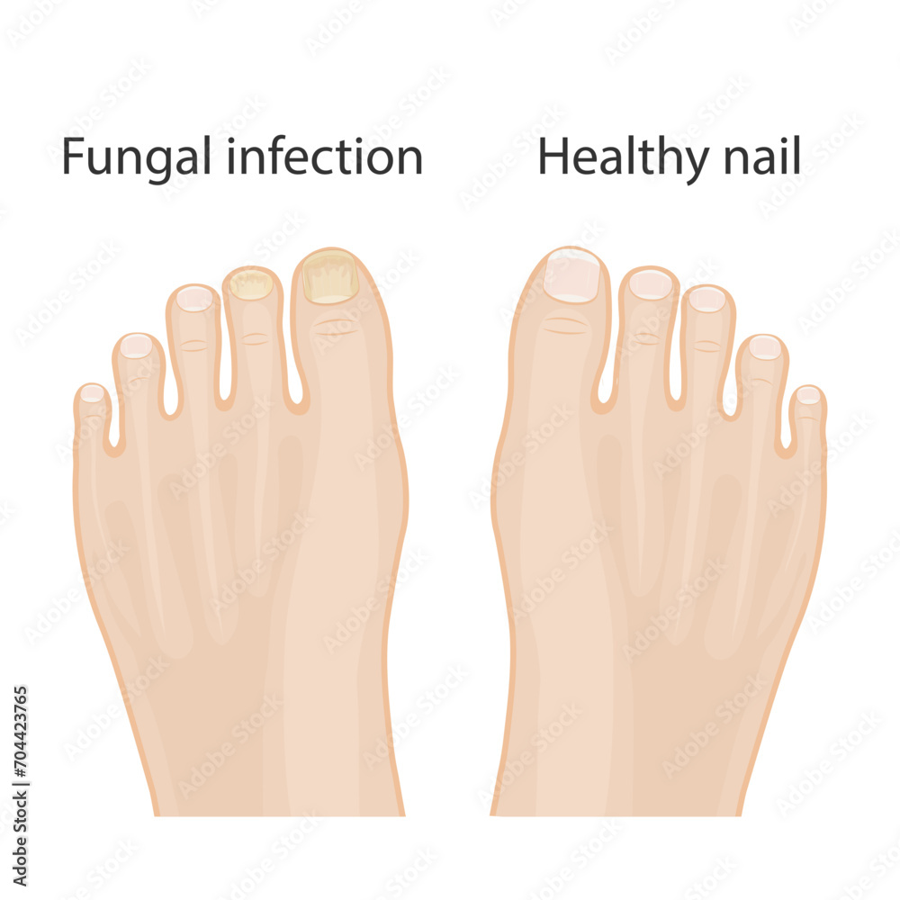 Obraz premium Nail diseases. Onychomycosis, causes of fungal nail infection. Medical infographic design