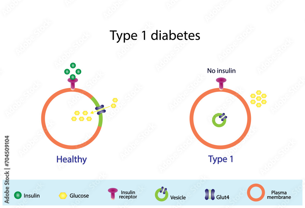 Diabetes mellitus type 1, pancreas's failure to produce enough insulin