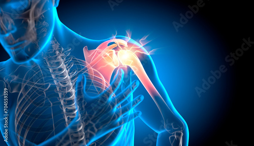 Fotografie X-ray 3D Illustration of Pain in Shoulder Joint - 3D Illustration